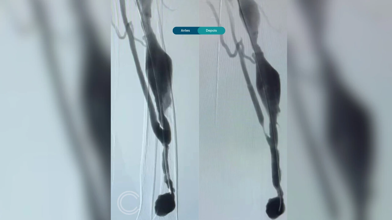 CSSJD realiza com sucesso o primeiro procedimento de recuperação de fístula arteriovenosa do projeto “FAVorecer”