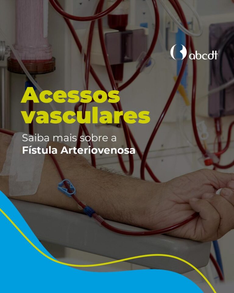 Acessos Vasculares: Saiba mais sobre Fístula Arteriovenosa